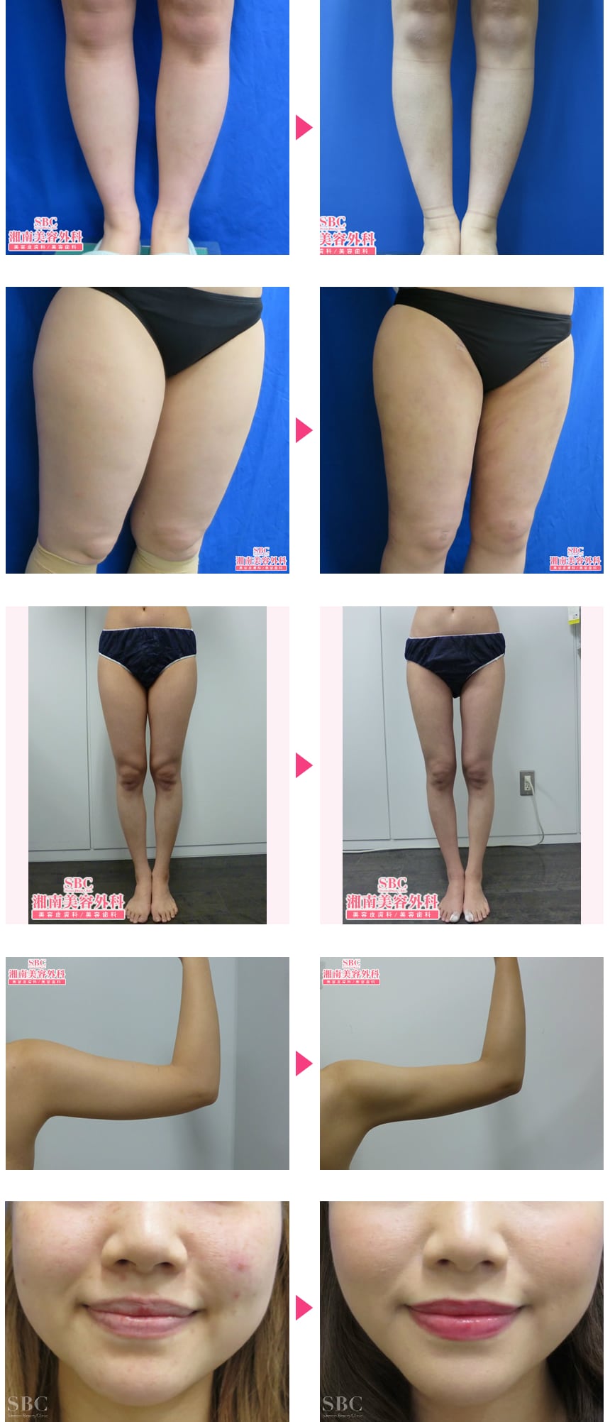 人数限定】丁寧なカウンセリングでオーダ…｜脂肪吸引モニター募集