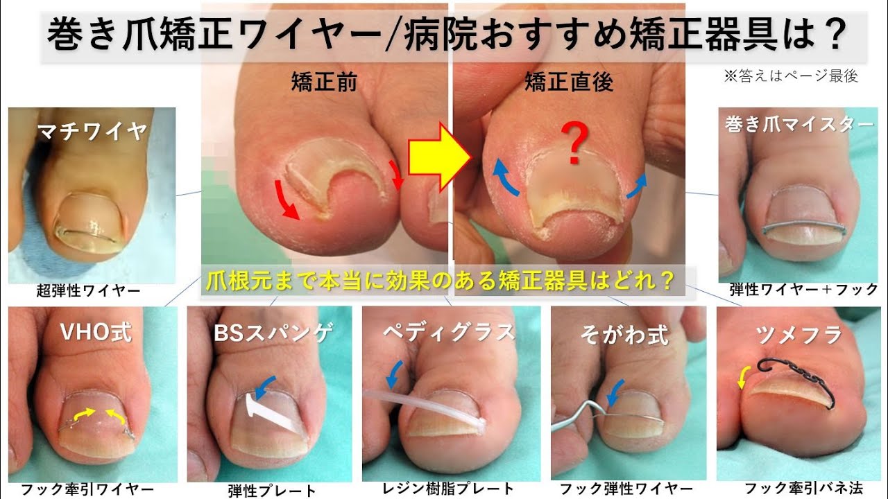 巻き爪矯正ワイヤー治療/病院おすすめ矯正器具の効果｜大田区大森